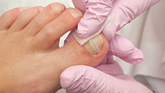 toenail treatment