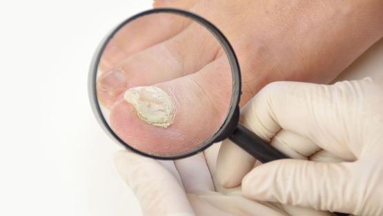 fungal nail treatment